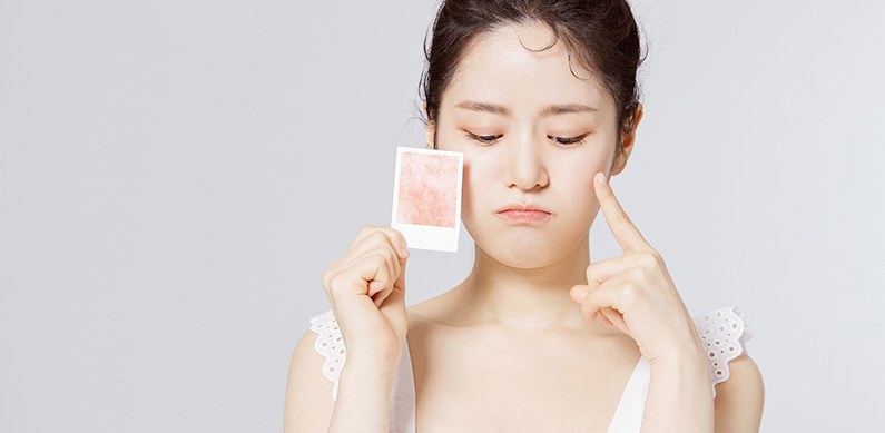 여드름