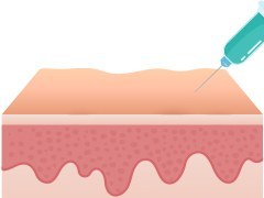 상담 및 검사 후
녹는 실(PDO)을 피부 아래에 주입